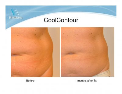 coolcontour funkar det