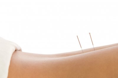 /health-acupuncture-effective-healing-or-placebo.jpg