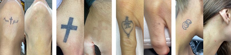 Bild före och efter tatueringsborttagning. Kontakta oss om du vill ta bort en tatuering.