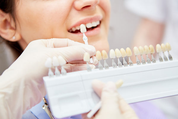 Tandblekning Stockholm - Solna Dental - färgprov