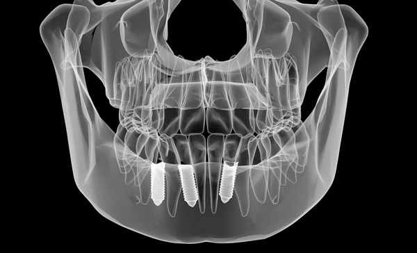 röntgenbild tandimplantat