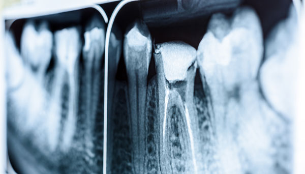 röntgenbild på tand inför rotfyllning