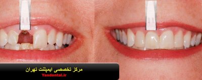 خدمات دندانپزشکی , ایمپلنت , لمینت , بلچینگ و لیمونیرز